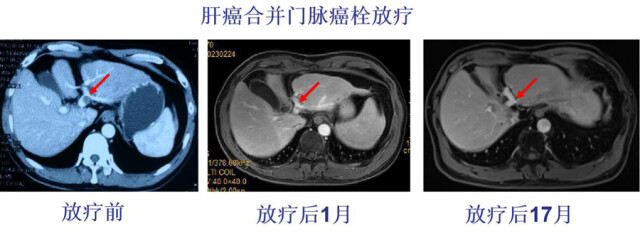 无形的刀肝癌的放射治疗